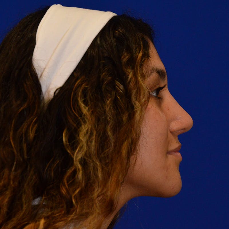 Ethnic Rhinoplasty Before & After Gallery - Patient 407842 - Image 4