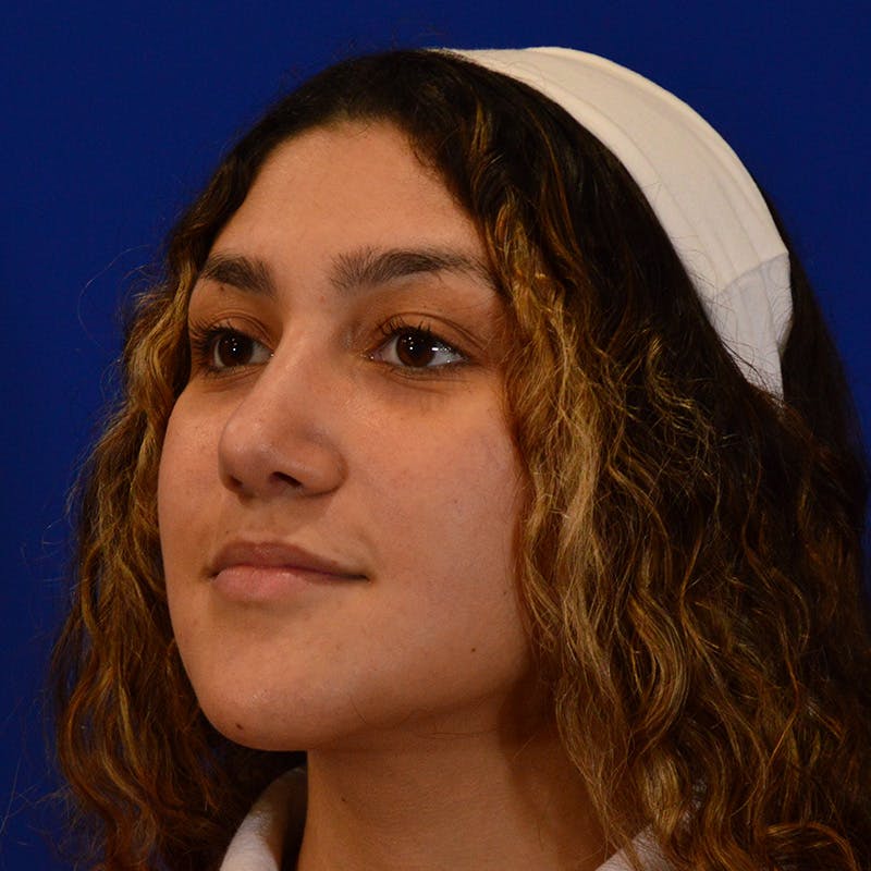 Ethnic Rhinoplasty Before & After Gallery - Patient 407842 - Image 8