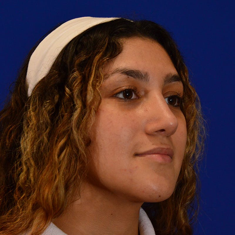 Ethnic Rhinoplasty Before & After Gallery - Patient 407842 - Image 10
