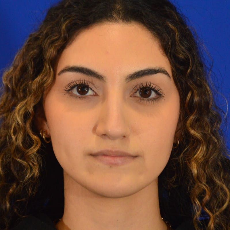 Female Rhinoplasty Before & After Gallery - Patient 811288 - Image 6