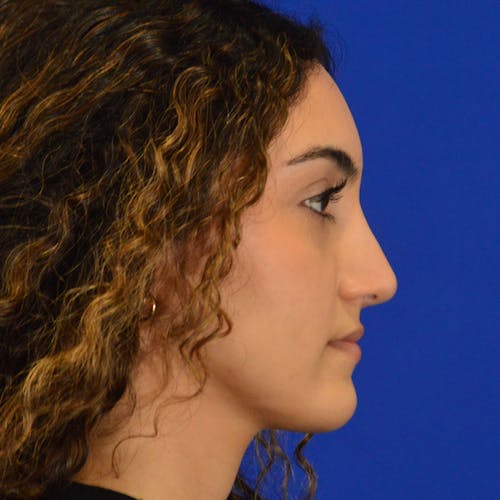 rhinoplasty patient after Beverly Hills by Dr. Torkian