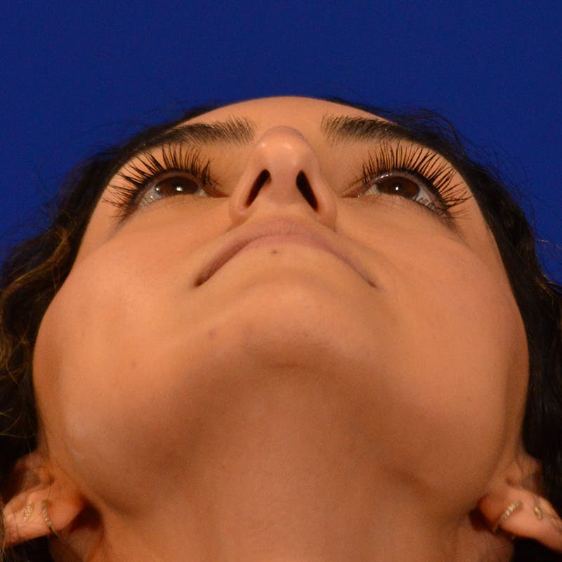 Female Rhinoplasty Before & After Gallery - Patient 811288 - Image 13