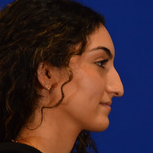 rhinoplasty patient before Beverly Hills by Dr. Torkian