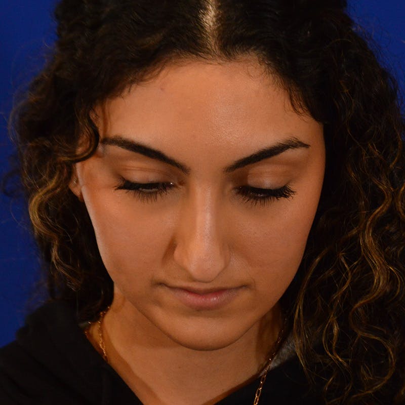 Female Rhinoplasty Before & After Gallery - Patient 811288 - Image 11