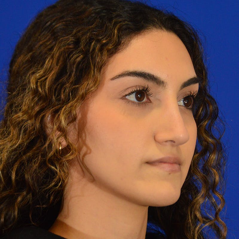 Female Rhinoplasty Before & After Gallery - Patient 811288 - Image 8