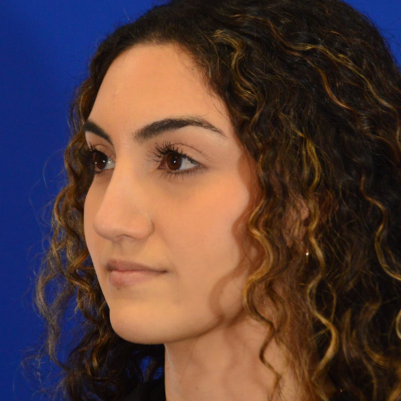 Female Rhinoplasty Before & After Gallery - Patient 811288 - Image 10