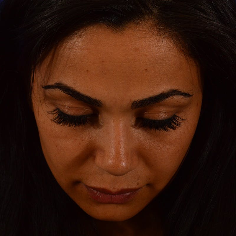 Ethnic Rhinoplasty Before & After Gallery - Patient 191323 - Image 13