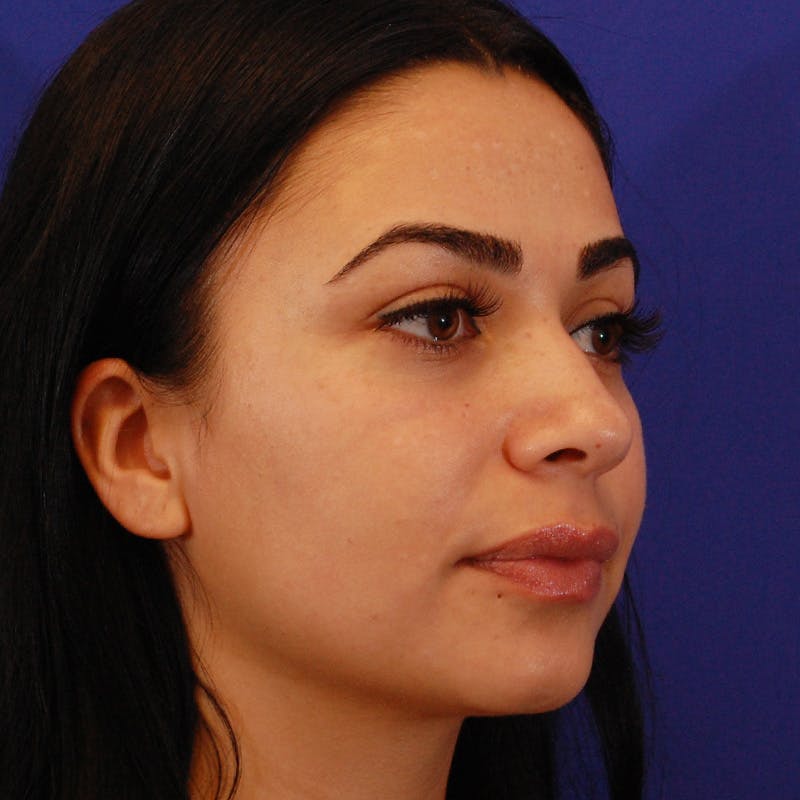 Ethnic Rhinoplasty Before & After Gallery - Patient 191323 - Image 5