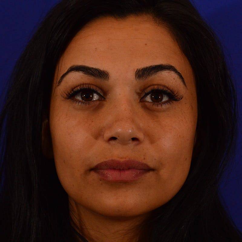 Ethnic Rhinoplasty Before & After Gallery - Patient 191323 - Image 4