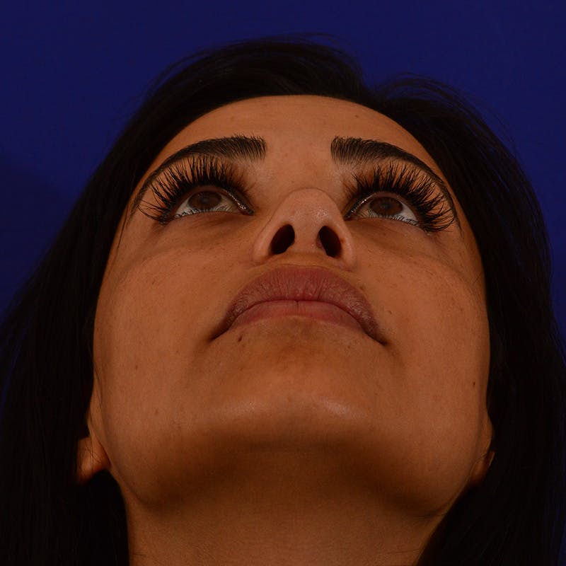 Ethnic Rhinoplasty Before & After Gallery - Patient 191323 - Image 12