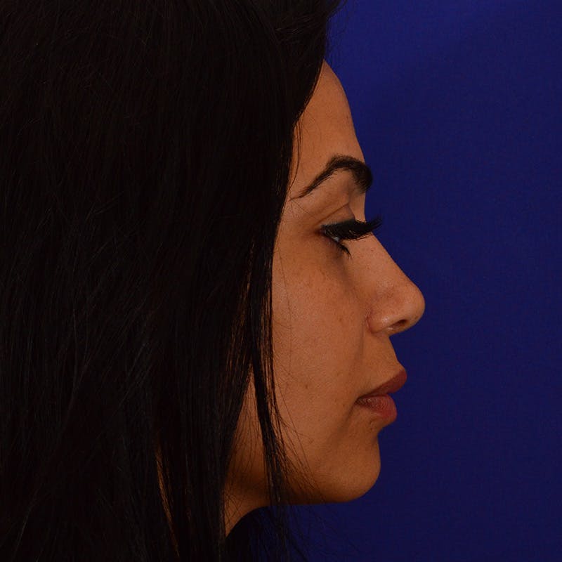 Ethnic Rhinoplasty Before & After Gallery - Patient 191323 - Image 2