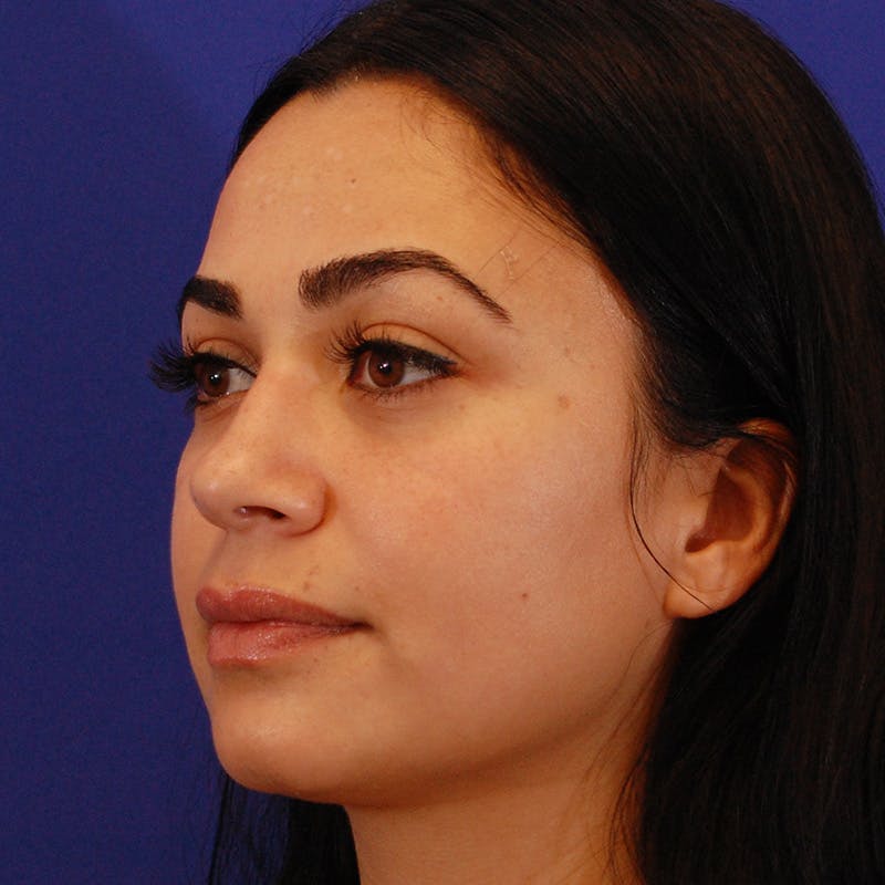 Ethnic Rhinoplasty Before & After Gallery - Patient 191323 - Image 7