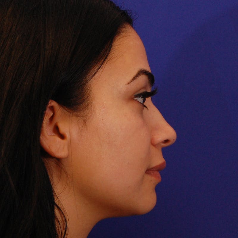 Ethnic Rhinoplasty Before & After Gallery - Patient 191323 - Image 1