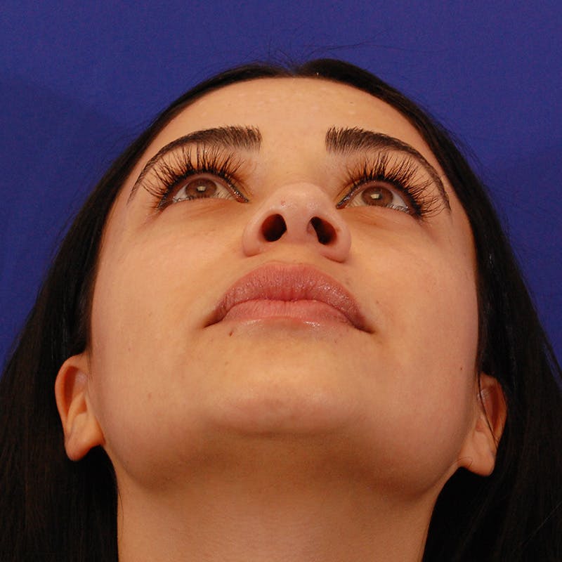Ethnic Rhinoplasty Before & After Gallery - Patient 191323 - Image 11