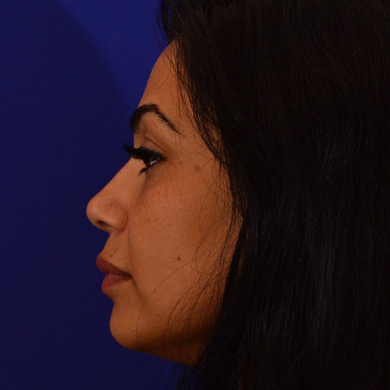 Ethnic Rhinoplasty Before & After Gallery - Patient 191323 - Image 10