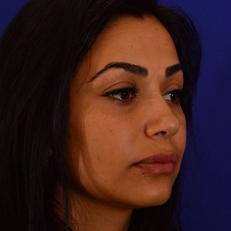 Ethnic Rhinoplasty Before & After Gallery - Patient 191323 - Image 6