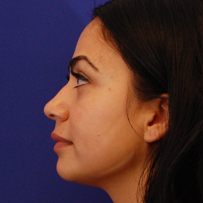 Ethnic Rhinoplasty Before & After Gallery - Patient 191323 - Image 9