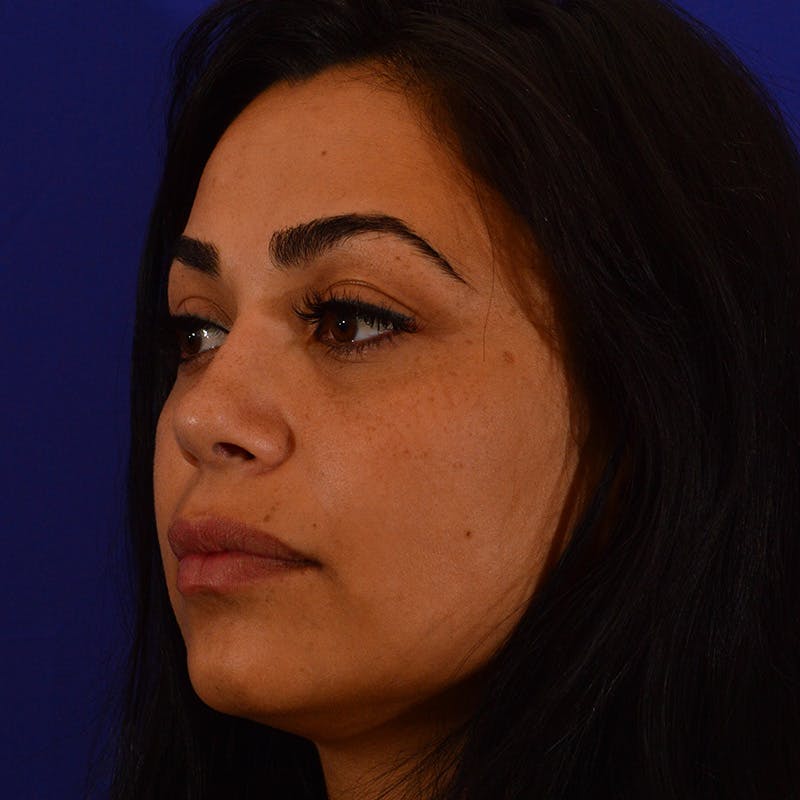 Ethnic Rhinoplasty Before & After Gallery - Patient 191323 - Image 8