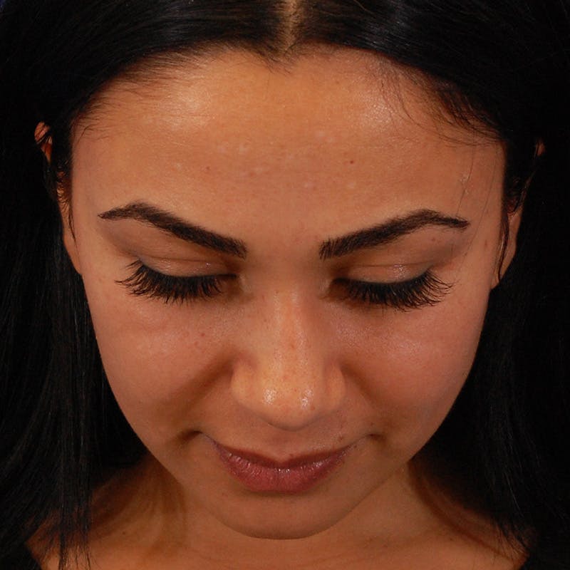 Ethnic Rhinoplasty Before & After Gallery - Patient 191323 - Image 14