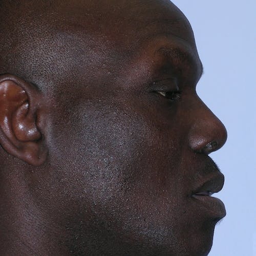 male rhinoplasty patient Beverly Hills by Dr. Torkian