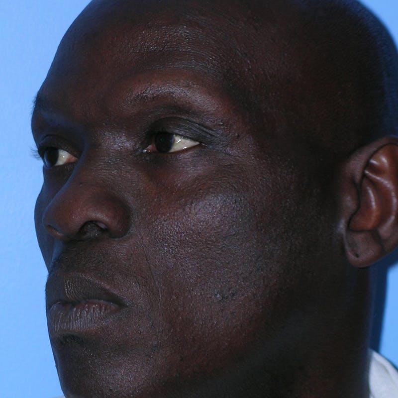 Male Rhinoplasty Before & After Gallery - Patient 292373 - Image 7