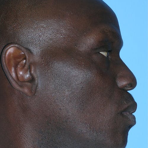 male rhinoplasty patient Beverly Hills by Dr. Torkian