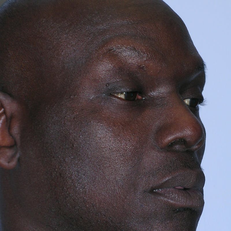 Male Rhinoplasty Before & After Gallery - Patient 292373 - Image 6