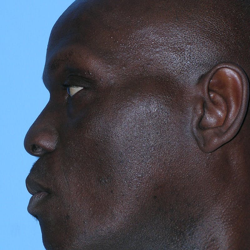 Male Rhinoplasty Before & After Gallery - Patient 292373 - Image 9