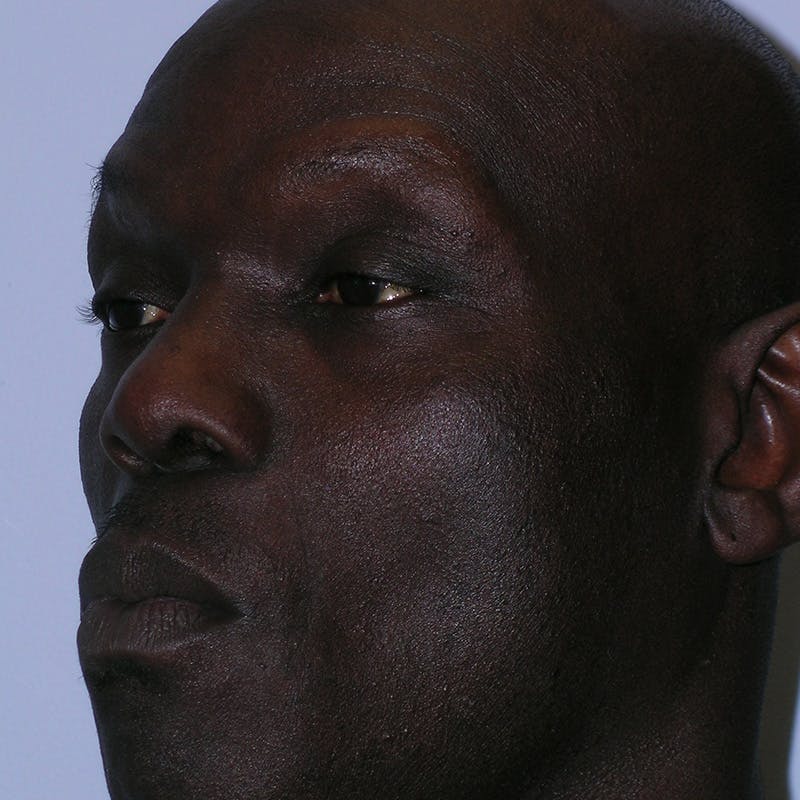 Male Rhinoplasty Before & After Gallery - Patient 292373 - Image 8