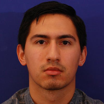 Chin Augmentation Before & After Gallery - Patient 294083 - Image 1