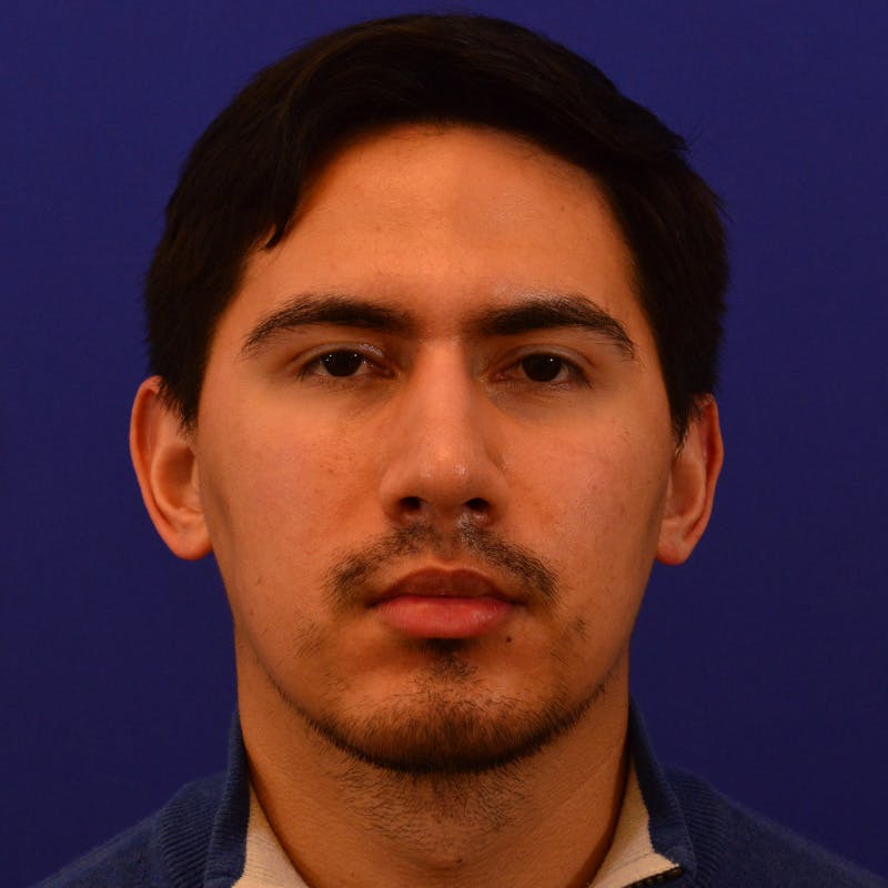 Male Rhinoplasty Before & After Gallery - Patient 193838 - Image 6