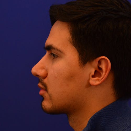 male rhinoplasty patient after Beverly Hills by Dr. Torkian