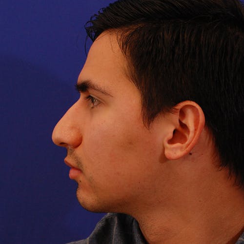 male rhinoplasty patient before Beverly Hills by Dr. Torkian