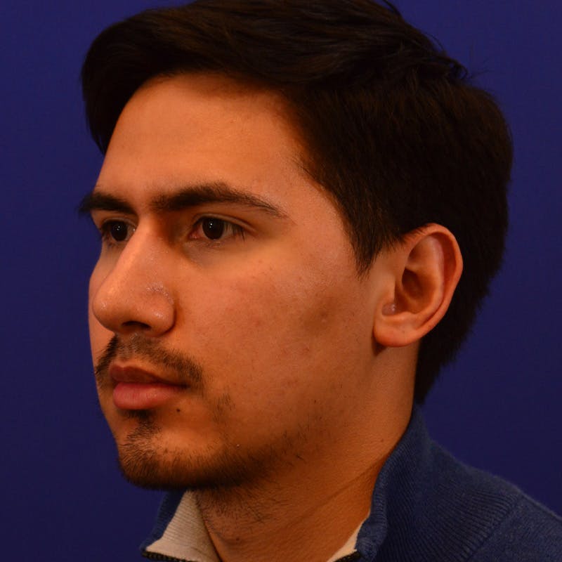 Male Rhinoplasty Before & After Gallery - Patient 193838 - Image 10