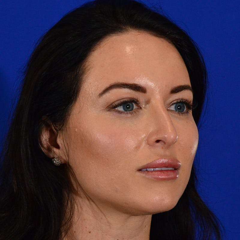 Female Rhinoplasty Before & After Gallery - Patient 475475 - Image 5