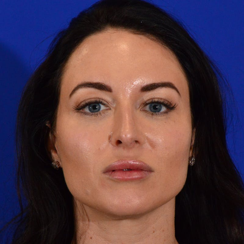 Female Rhinoplasty Before & After Gallery - Patient 475475 - Image 4