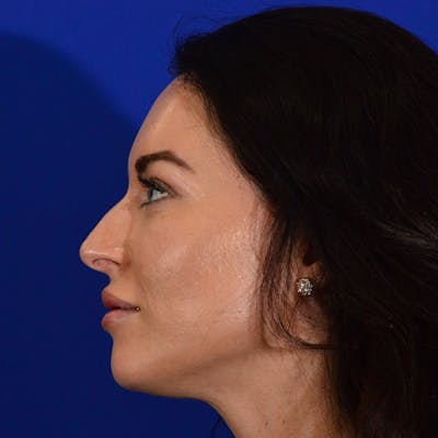 Dorsal Hump Before & After Gallery - Patient 672078 - Image 1