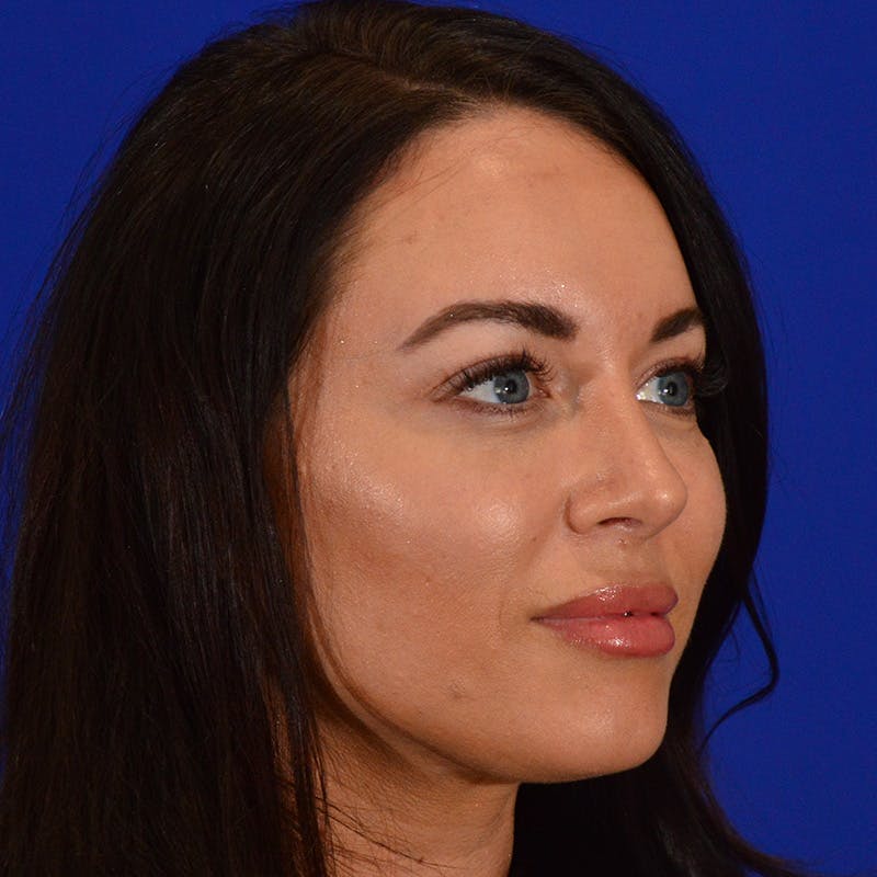 Female Rhinoplasty Before & After Gallery - Patient 475475 - Image 6