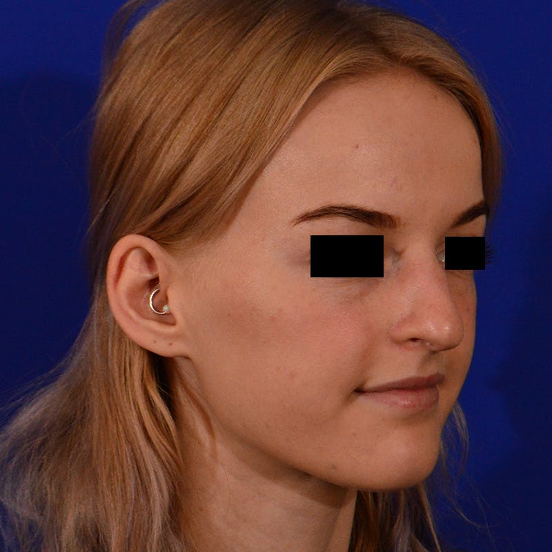 Female Rhinoplasty Before & After Gallery - Patient 340304 - Image 5