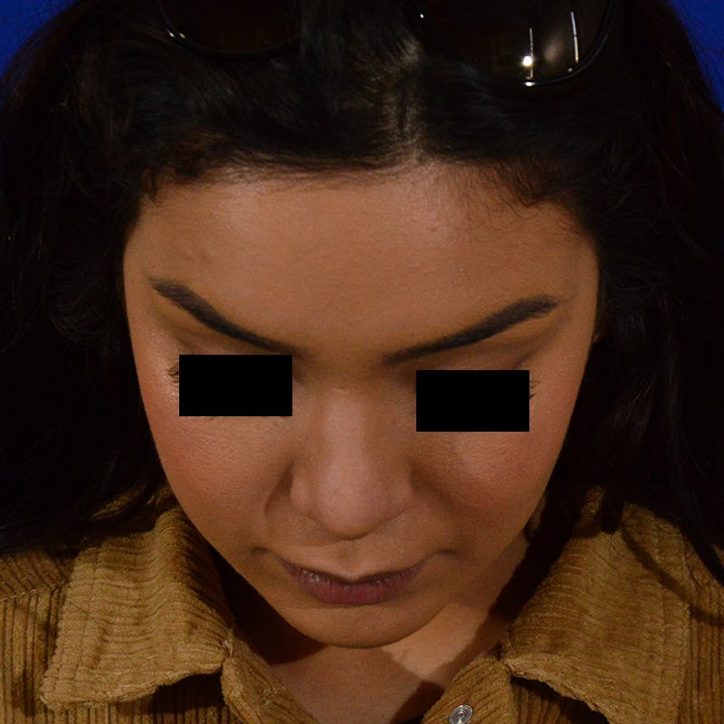 Female Rhinoplasty Before & After Gallery - Patient 168003 - Image 14