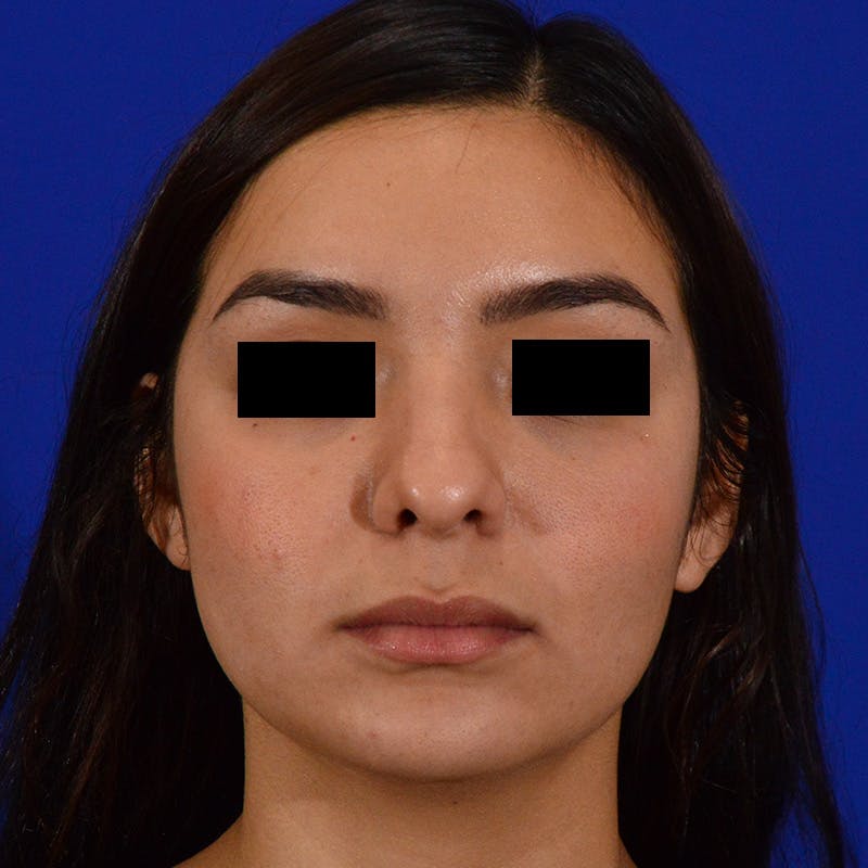Female Rhinoplasty Before & After Gallery - Patient 168003 - Image 3