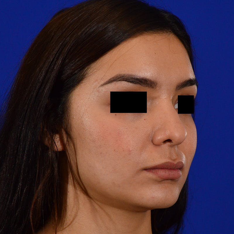 Female Rhinoplasty Before & After Gallery - Patient 168003 - Image 5