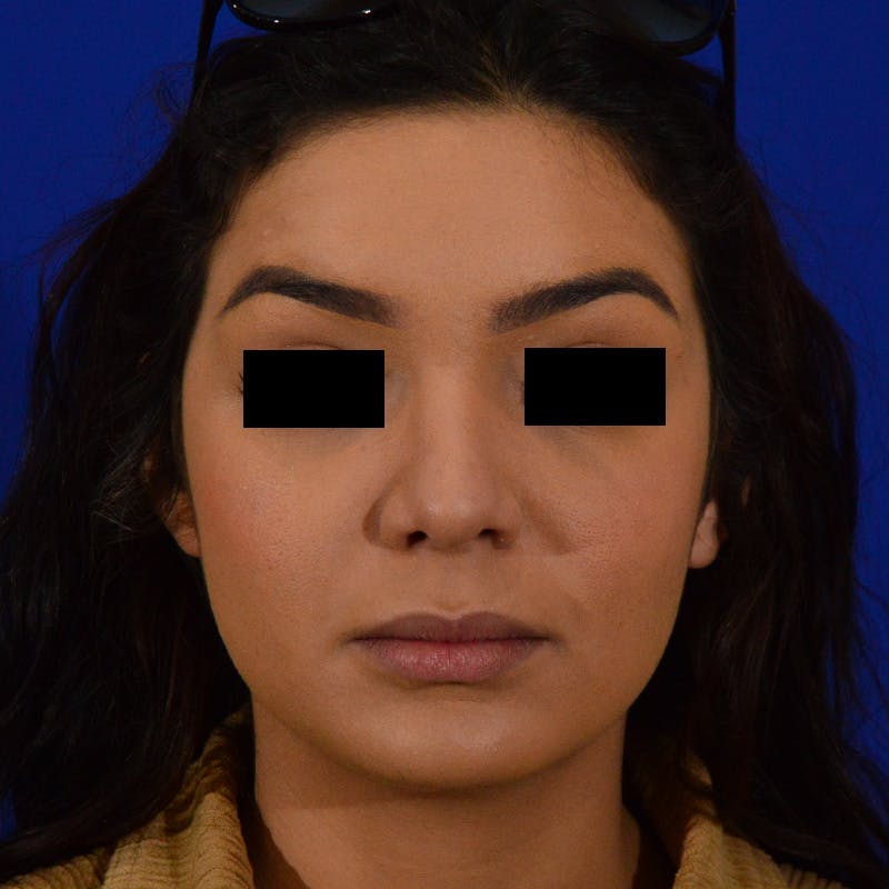 Female Rhinoplasty Before & After Gallery - Patient 168003 - Image 4