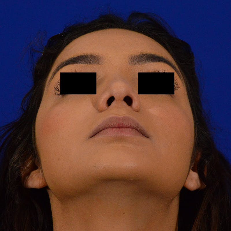 Female Rhinoplasty Before & After Gallery - Patient 168003 - Image 12