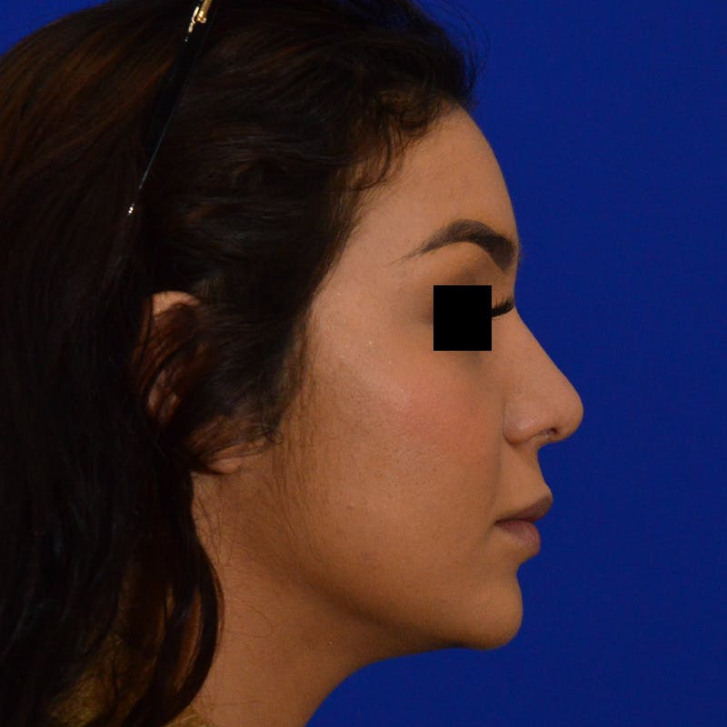 Female Rhinoplasty Before & After Gallery - Patient 168003 - Image 8