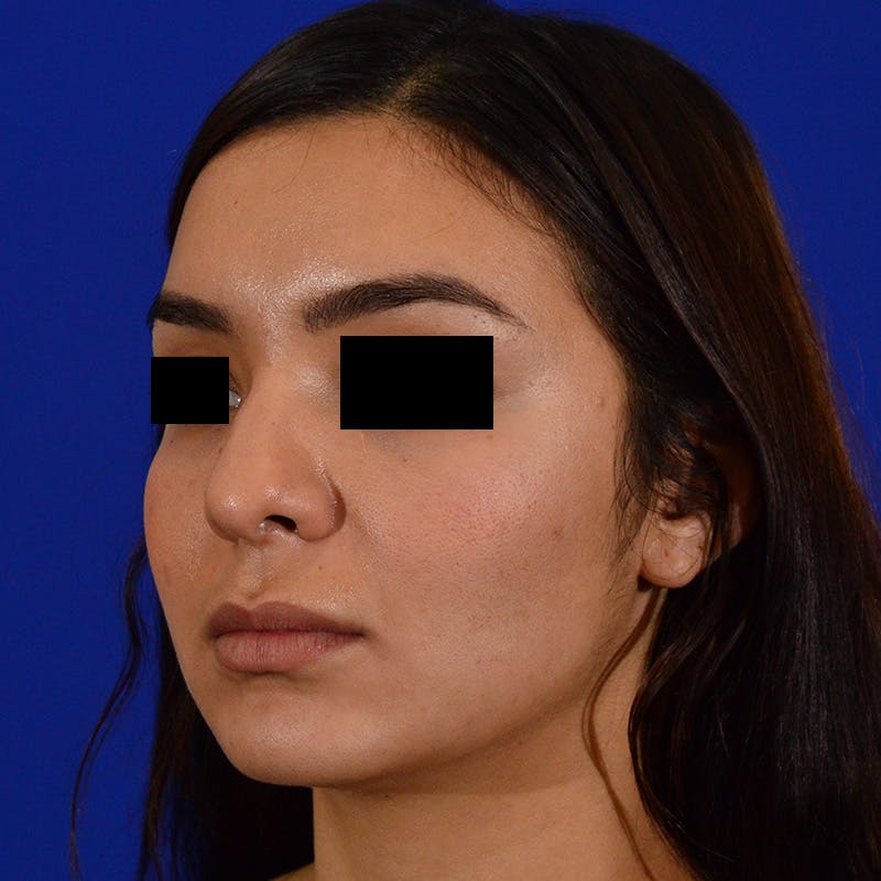 Female Rhinoplasty Before & After Gallery - Patient 168003 - Image 9