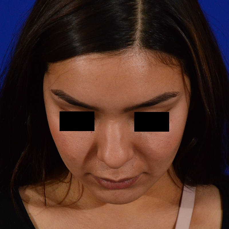 Female Rhinoplasty Before & After Gallery - Patient 168003 - Image 13