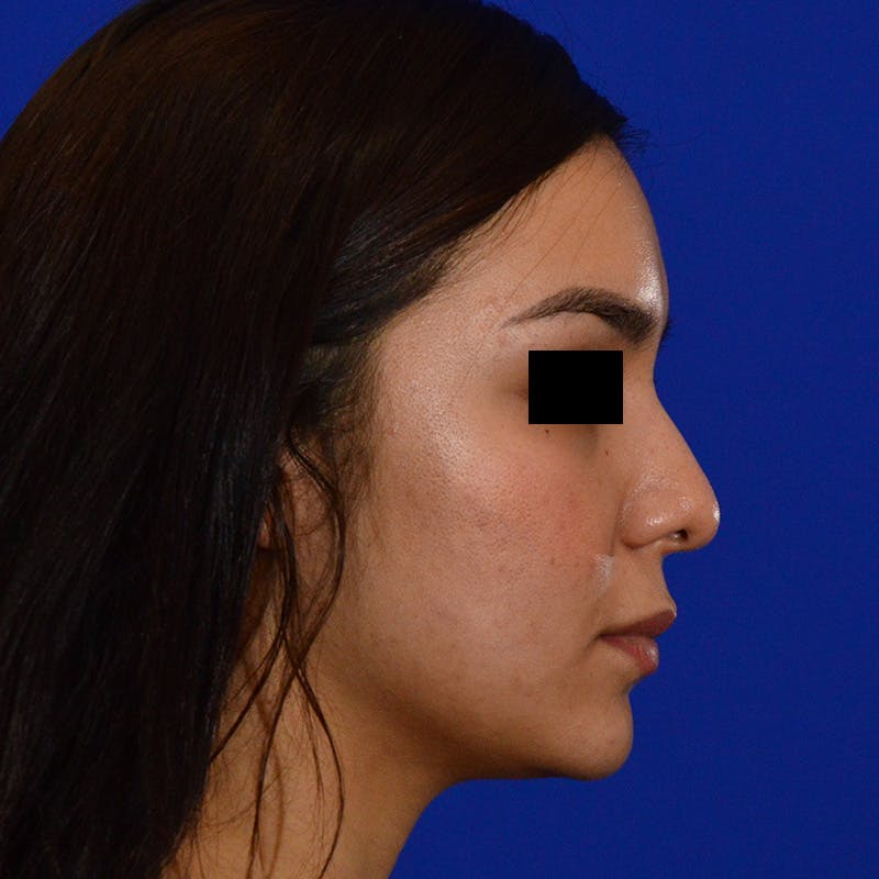 Female Rhinoplasty Before & After Gallery - Patient 168003 - Image 7