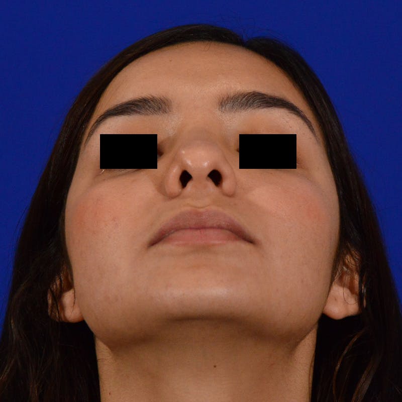 Female Rhinoplasty Before & After Gallery - Patient 168003 - Image 11