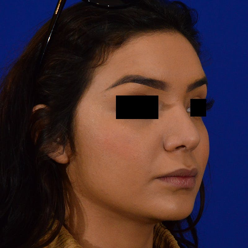 Female Rhinoplasty Before & After Gallery - Patient 168003 - Image 6